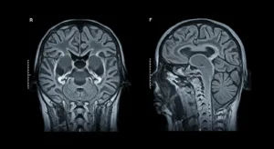 Slider comparing a T1-weighted MRI image with a T2-weighted MRI image. Shows how different MRI sequences highlight different tissue characteristics by changing the image contrast.
