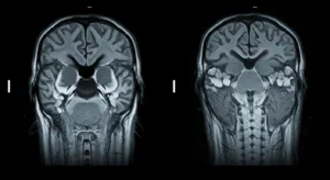Slider comparing a T1-weighted MRI image with a T2-weighted MRI image. Shows how different MRI sequences highlight different tissue characteristics by changing the image contrast.