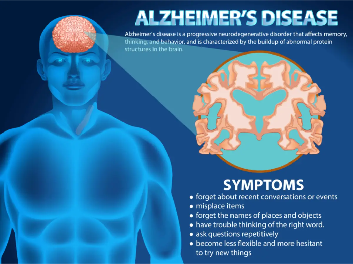 Informative poster of Alzheimer's disease.