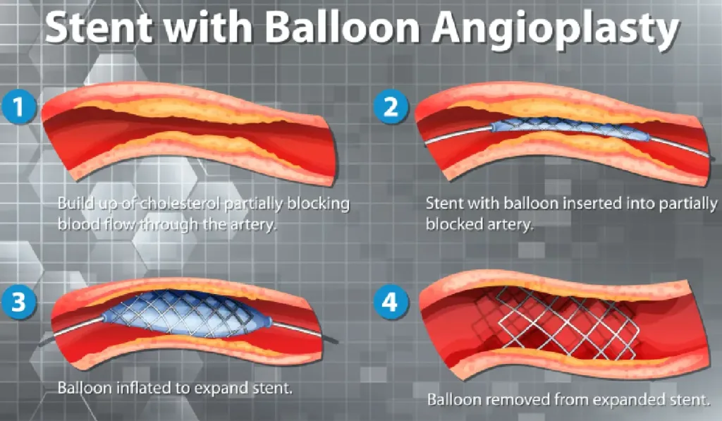 Cardiac interventions diagram showing coronary stent placement, bypass surgery, and valve replacement procedures with anatomical details.